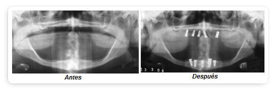 RADIOGRAFIA DE IMPLANTES DENTALES
